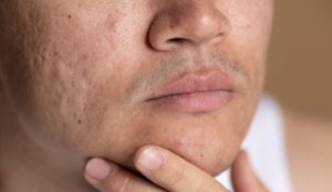 Principais causas de manchas na pele e como tratá-las